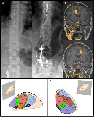 Editorial: Surgical techniques for the management of pain